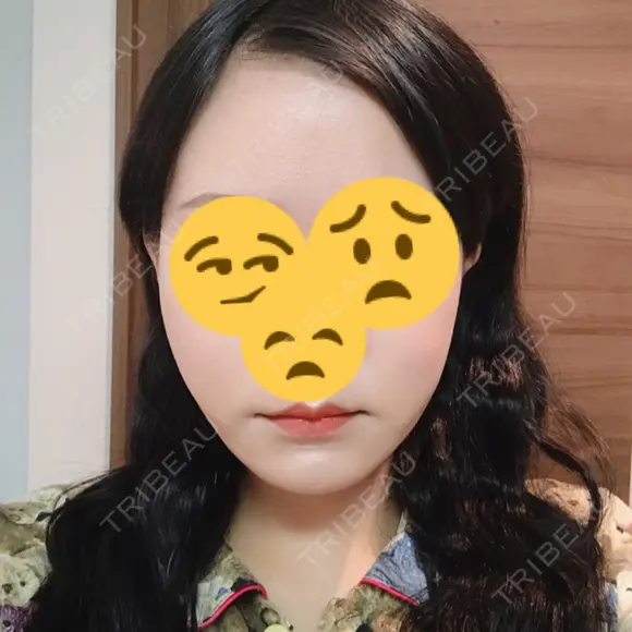 糸リフト / 脂肪吸引（顔） / その他（肌） ビューティーライン美容外科 DAY 17 メイン用