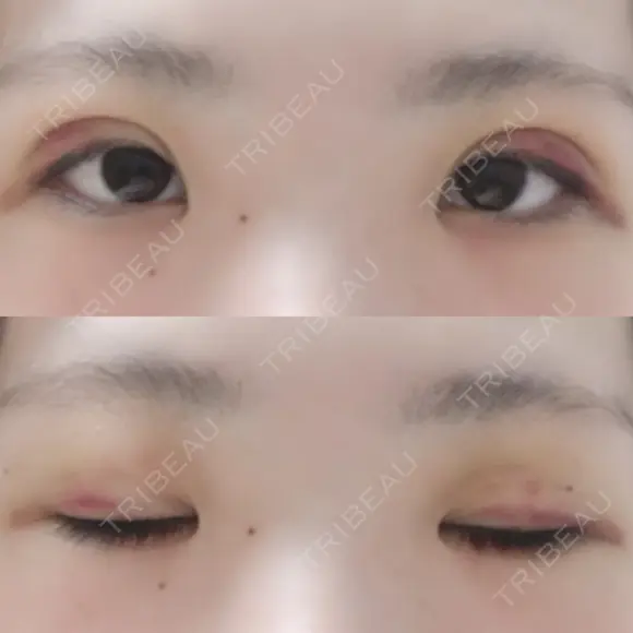 二重埋没 / 上まぶたの脂肪取り 湘南美容クリニック 京都院 DAY 5 メイン用