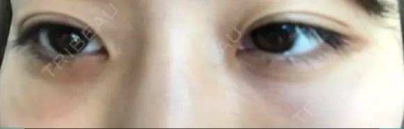 下まぶたたるみ取り セオリークリニック DAY 7 メイン用