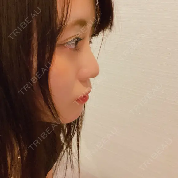 隆鼻術 / 鼻尖形成（切開） サラ美容外科 DAY 55 メイン用