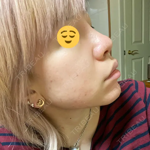 隆鼻術 品川美容外科 名古屋院 DAY 4 メイン用