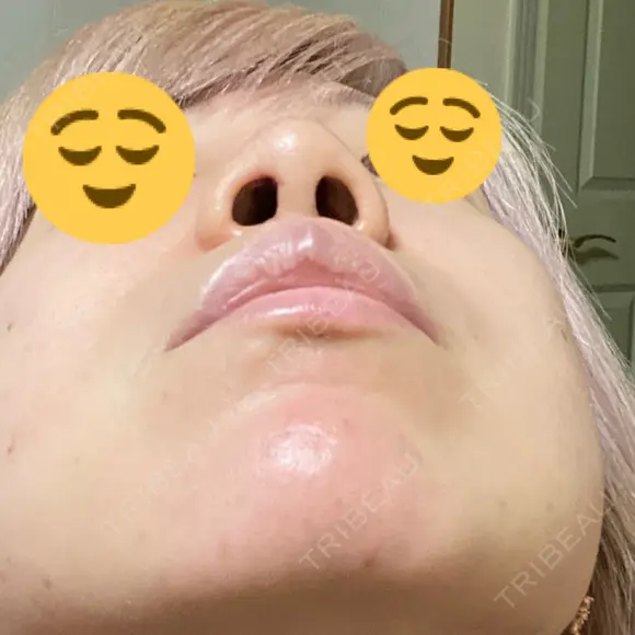 隆鼻術 品川美容外科 名古屋院 DAY 4 メイン用