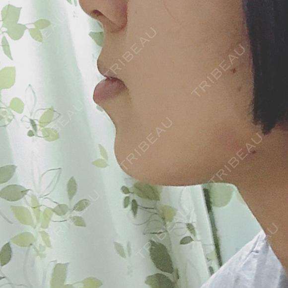 ボトックス（あご） 湘南美容クリニック 名古屋栄院 DAY 7 メイン用