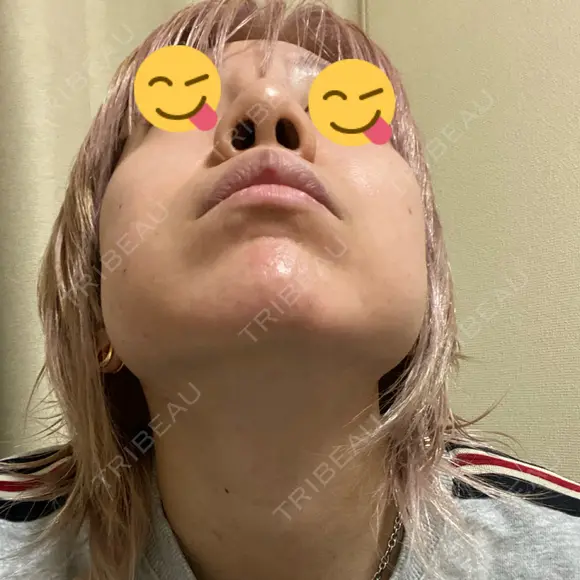 隆鼻術 品川美容外科 名古屋院 DAY 5 メイン用