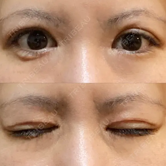 二重切開 / その他（目元） RG整形外科（旧リオン整形外科） DAY 62 メイン用