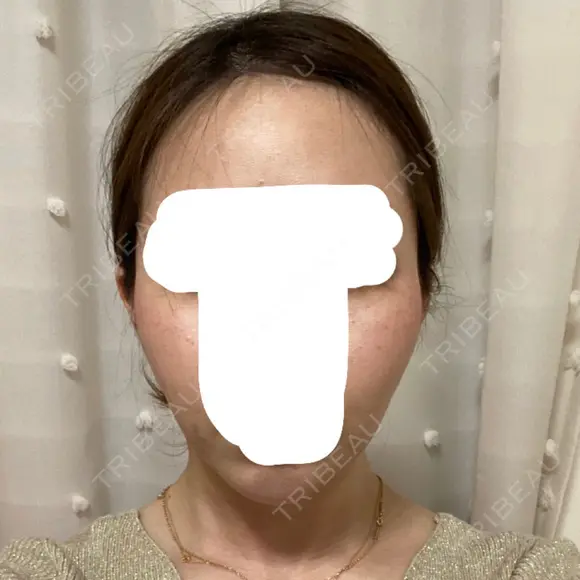 バッカルファット除去 / 脂肪吸引（顔） / ボトックス（あご） / 水光注射（ハリ・美肌） / ヒアルロン酸注入（あご） / ボトックス（エラ・小顔） / 脂肪溶解注射（顔） / ヒアルロン酸注入（唇） エートップ美容整形外科 AFTER メイン用