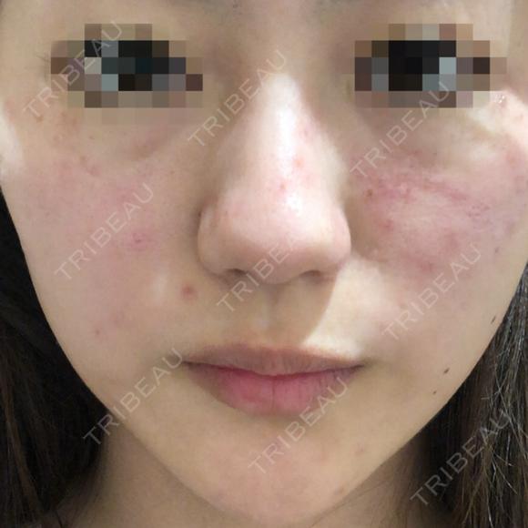 ピコレーザートーニング（美白・肝斑） UB CLINIC 銀座 DAY 0 メイン用