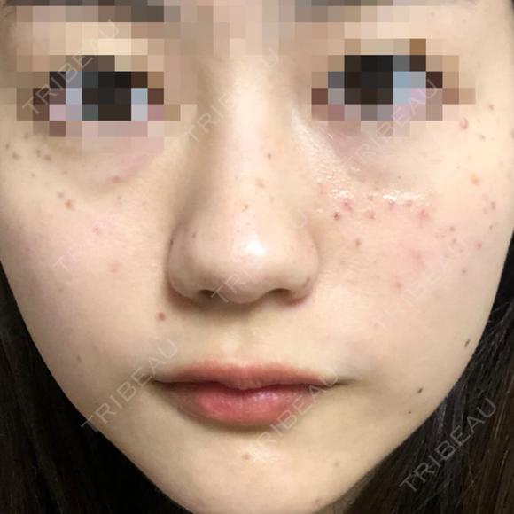 ピコレーザートーニング（美白・肝斑） UB CLINIC 銀座 DAY 0 メイン用