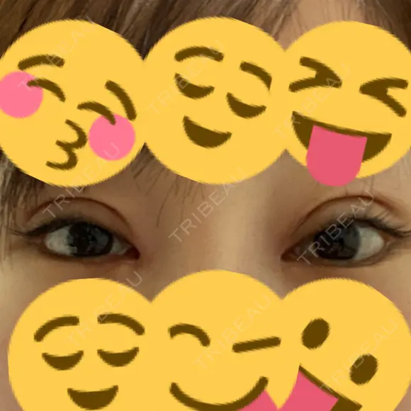 二重切開 / 目頭切開 / 鼻尖形成（切開） / 鼻中隔延長（切開） / 小鼻縮小（切開） / タレ目形成・グラマラスライン（切開） / 鼻尖縮小 / 鼻翼基部形成（貴族手術） グローバルビューティークリニック 大阪院 DAY 25 メイン用