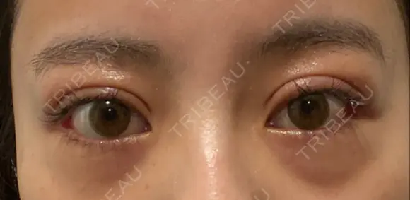 二重切開 / 眼瞼下垂（切開） / 目尻切開 / 上まぶたの脂肪取り / タレ目形成・グラマラスライン（切開） id（アイディ）美容外科 DAY 29 メイン用
