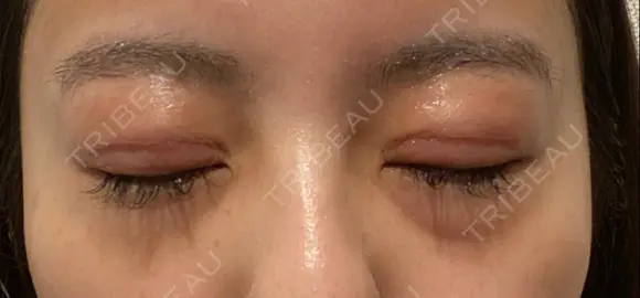 二重切開 / 眼瞼下垂（切開） / 目尻切開 / 上まぶたの脂肪取り / タレ目形成・グラマラスライン（切開） id（アイディ）美容外科 DAY 29 メイン用
