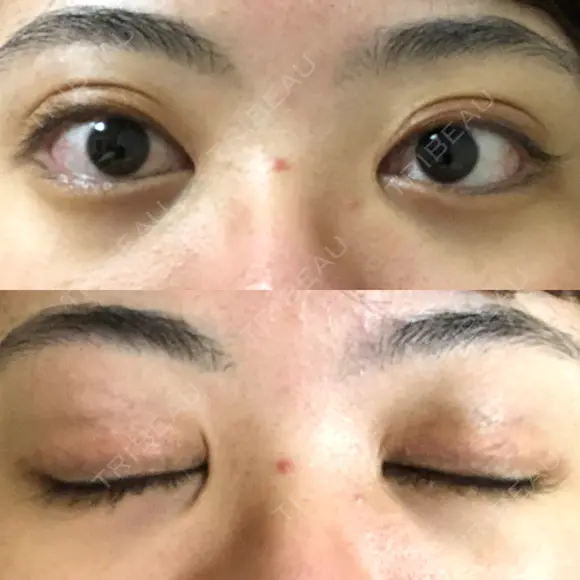 二重切開 / 目頭切開 / ほくろ・いぼ切除（肌） / 上まぶたたるみ取り / 上まぶたの脂肪取り 東京美容外科 銀座院 AFTER メイン用