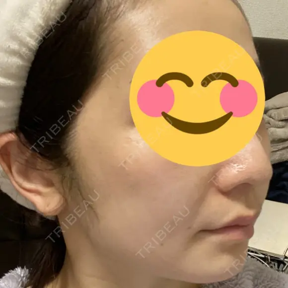 骨削り（頬） RG整形外科（旧リオン整形外科） DAY 26 メイン用