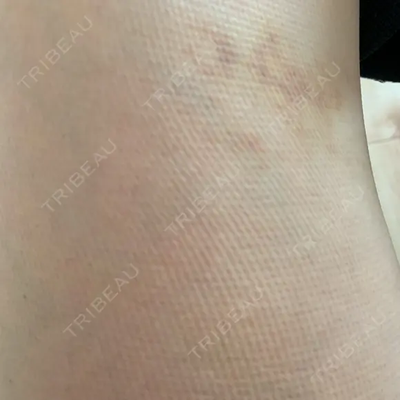 脂肪吸引（脚） 宇都宮竹内クリニック DAY 14 メイン用