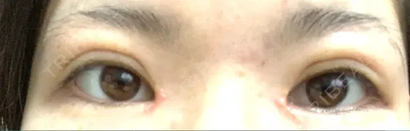 二重埋没 / 目頭切開 / 上まぶたの脂肪取り 湘南美容クリニック 高松院 AFTER メイン用