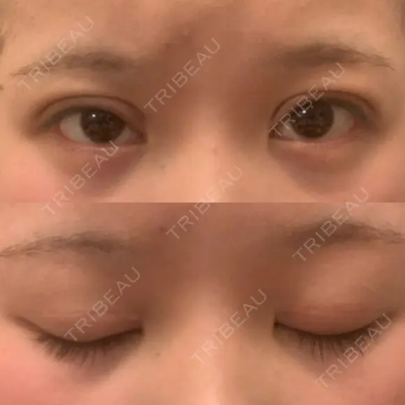 二重切開 大阪梅田中央クリニック美容外科 AFTER メイン用