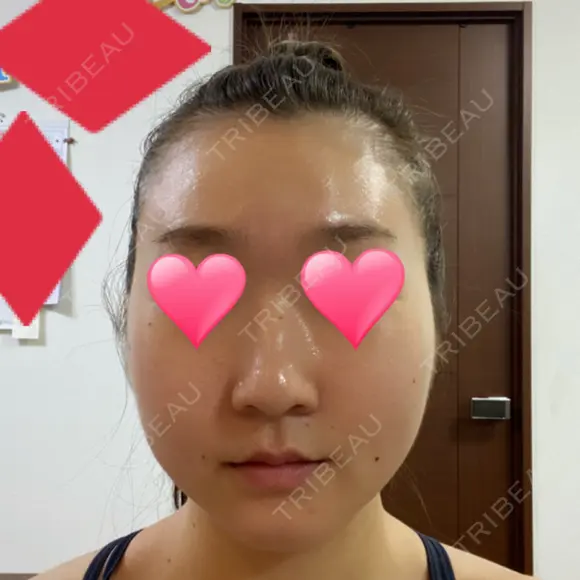 骨切り（あご） / 骨削り（エラ） / 骨削り（頬） バノバギ整形外科 DAY 37 メイン用