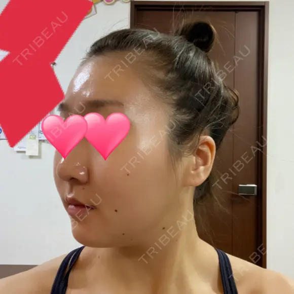 骨切り（あご） / 骨削り（エラ） / 骨削り（頬） バノバギ整形外科 DAY 37 メイン用