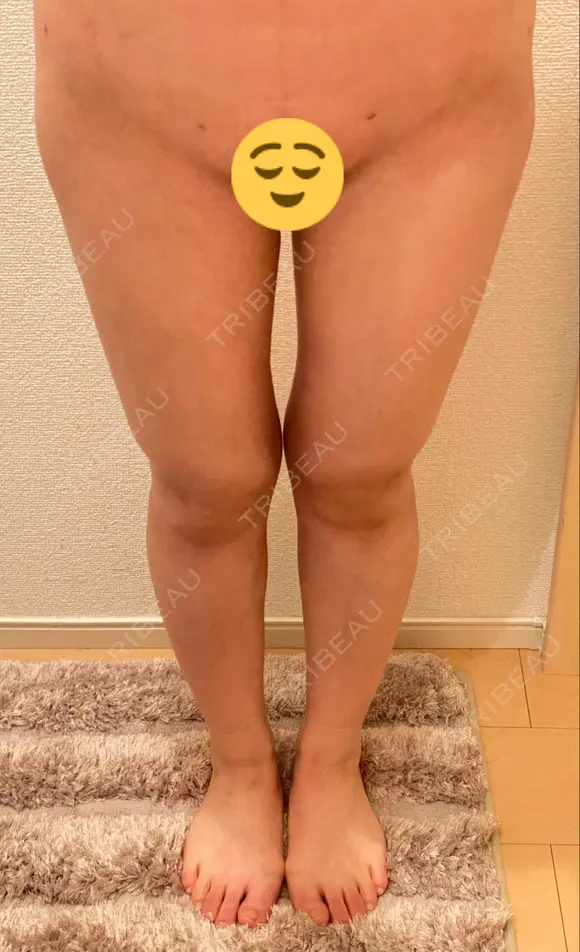 脂肪吸引（脚） / 脂肪吸引（お尻） ドクターフィット（Dr.fit）クリニック AFTER メイン用