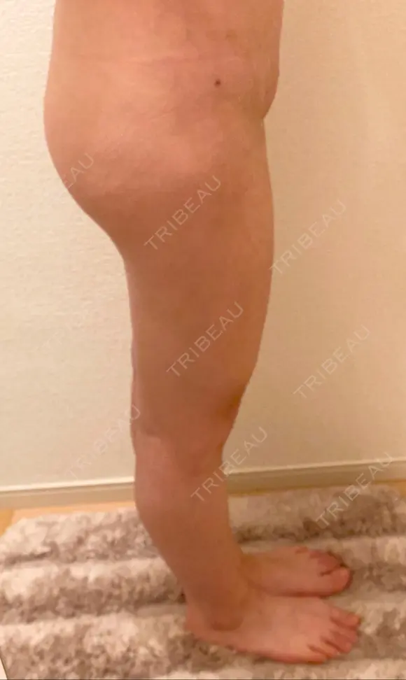 脂肪吸引（脚） / 脂肪吸引（お尻） ドクターフィット（Dr.fit）クリニック DAY 92 メイン用