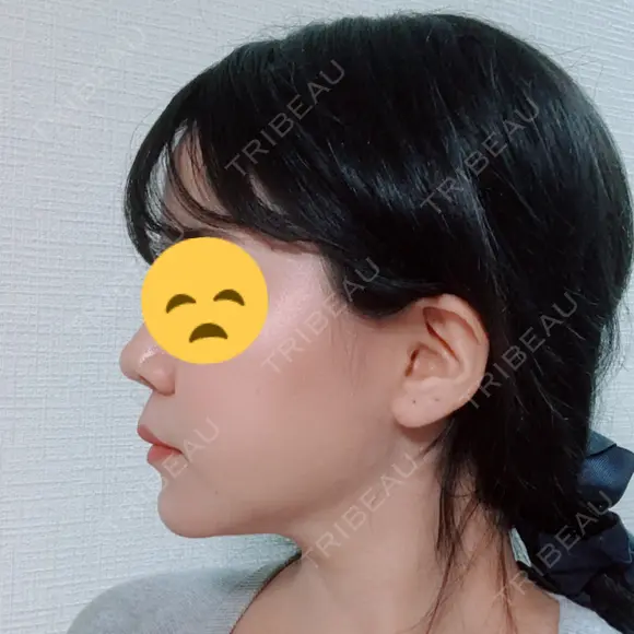 糸リフト / 脂肪吸引（顔） / その他（肌） ビューティーライン美容外科 DAY 24 メイン用