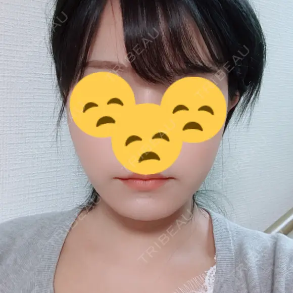 糸リフト / 脂肪吸引（顔） / その他（肌） ビューティーライン美容外科 DAY 24 メイン用