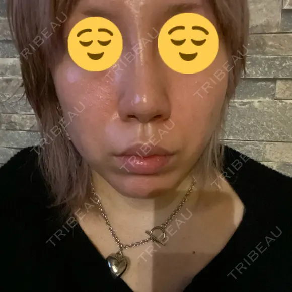 隆鼻術 品川美容外科 名古屋院 AFTER メイン用