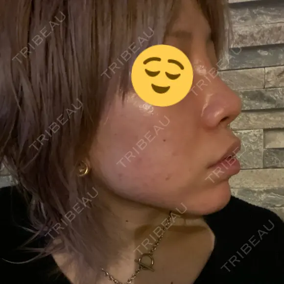 隆鼻術 品川美容外科 名古屋院 DAY 11 メイン用