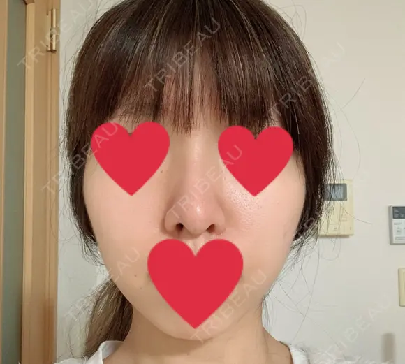 隆鼻術 / 鼻尖形成（切開） / 軟骨移植 湘南美容クリニック 名古屋栄院 AFTER メイン用