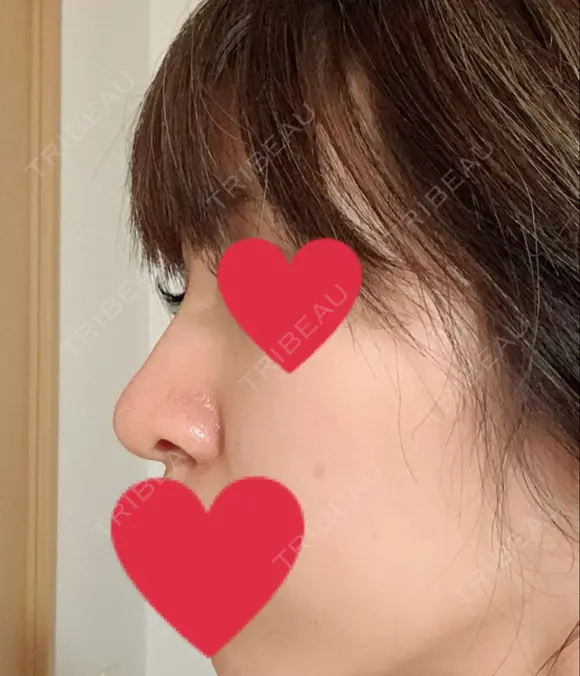 隆鼻術 / 鼻尖形成（切開） / 軟骨移植 湘南美容クリニック 名古屋栄院 DAY 73 メイン用