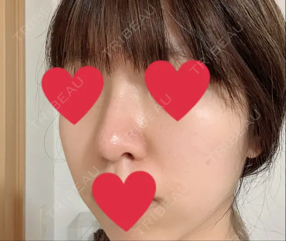 隆鼻術 / 鼻尖形成（切開） / 軟骨移植 湘南美容クリニック 名古屋栄院 DAY 73 メイン用