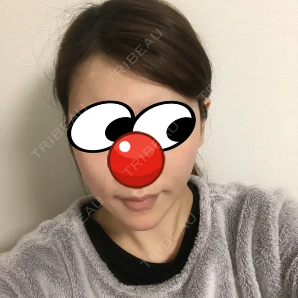 骨切り（あご） / 骨削り（エラ） / 脂肪注入（額） ボンディ美容整形外科（旧リオン整形外科） DAY 35 メイン用