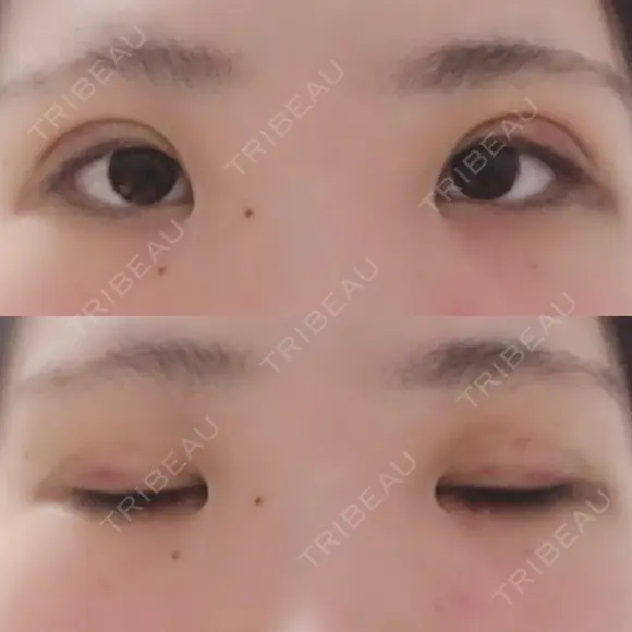 二重埋没 / 上まぶたの脂肪取り 湘南美容クリニック 京都院 AFTER メイン用