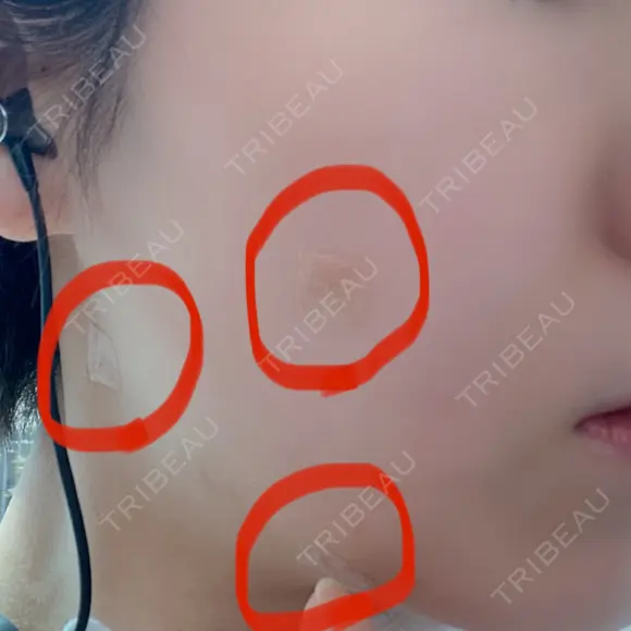 ほくろ・いぼ切除（肌） 赤坂メディカルMクリニック DAY 0 メイン用