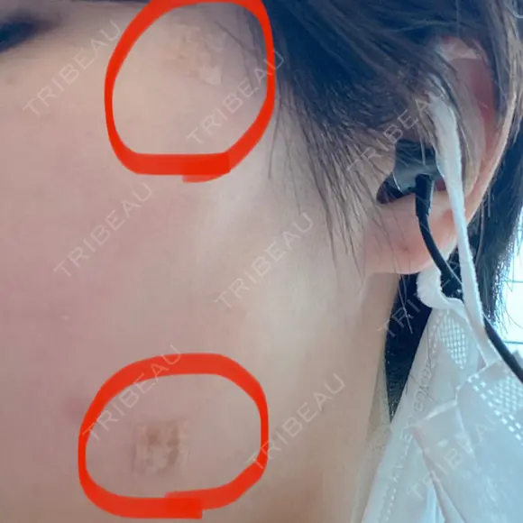 ほくろ・いぼ切除（肌） 赤坂メディカルMクリニック DAY 0 メイン用