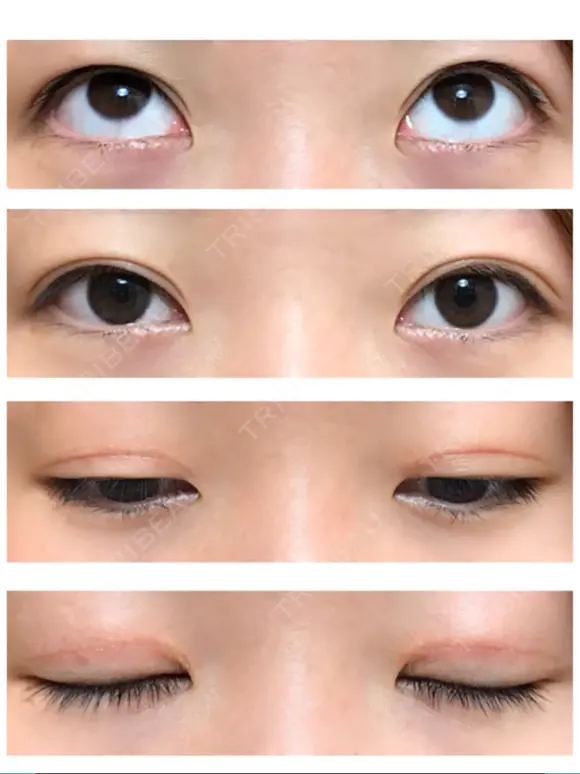 二重切開 / 上まぶたたるみ取り / 上まぶたの脂肪取り / 目元修正 リビジョンクリニック（旧：池本形成外科・美容外科） DAY 105 メイン用