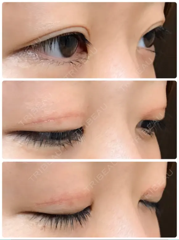 二重切開 / 上まぶたたるみ取り / 上まぶたの脂肪取り / 目元修正 リビジョンクリニック（旧：池本形成外科・美容外科） DAY 105 メイン用