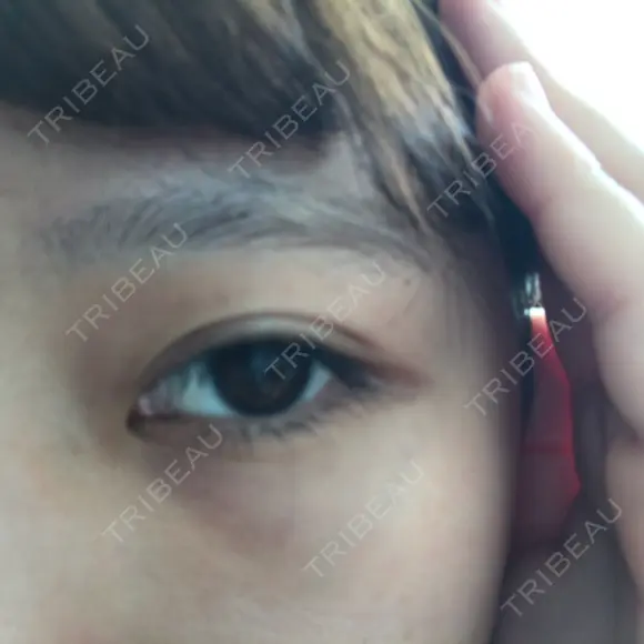 下まぶたたるみ取り セオリークリニック DAY 14 メイン用