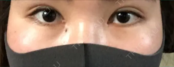二重埋没 / 目頭切開 / 上まぶたの脂肪取り 湘南美容クリニック 京都院 DAY 97 メイン用