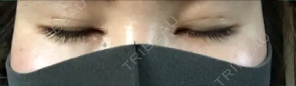 二重埋没 / 目頭切開 / 上まぶたの脂肪取り 湘南美容クリニック 京都院 DAY 97 メイン用