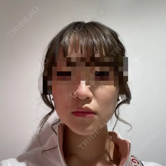 骨切り（あご） / 骨削り（エラ） ボンディ美容整形外科（旧リオン整形外科） AFTER メイン用