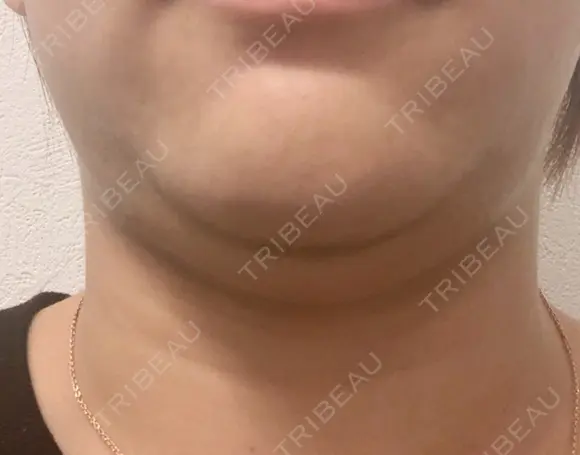 脂肪溶解注射（顔） リエンジャン整形外科 江南店 DAY 22 メイン用