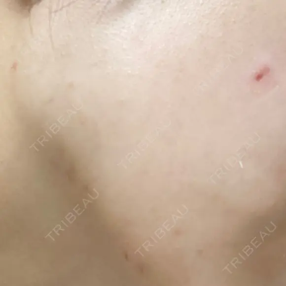 ほくろ・いぼ切除（肌） 赤坂メディカルMクリニック DAY 2 メイン用