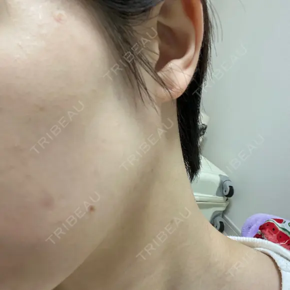 ほくろ・いぼ切除（肌） 赤坂メディカルMクリニック DAY 2 メイン用