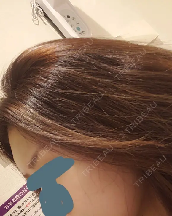 肌ヒアルロン酸注入（たるみ・シワ改善） 表参道スキンクリニック 表参道院 DAY 1 メイン用