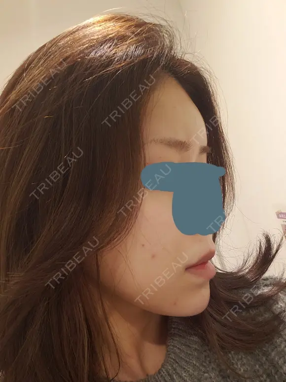 肌ヒアルロン酸注入（たるみ・シワ改善） 表参道スキンクリニック 表参道院 DAY 1 メイン用