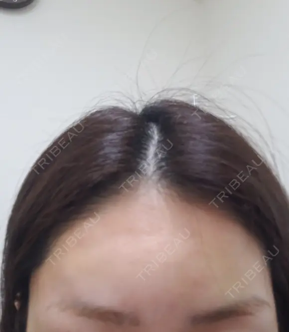 肌ヒアルロン酸注入（たるみ・シワ改善） 表参道スキンクリニック 表参道院 DAY 1 メイン用