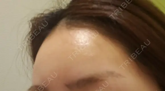 肌ヒアルロン酸注入（たるみ・シワ改善） 表参道スキンクリニック 表参道院 DAY 7 メイン用