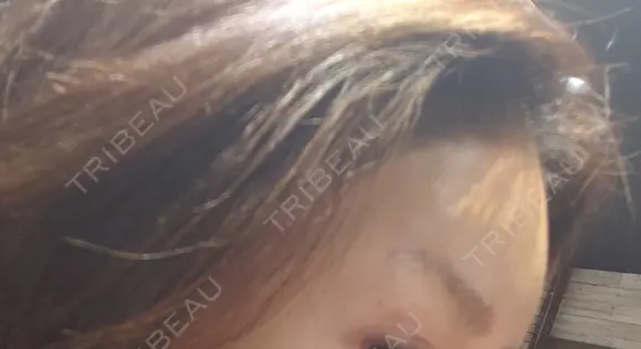 肌ヒアルロン酸注入（たるみ・シワ改善） 表参道スキンクリニック 表参道院 DAY 14 メイン用