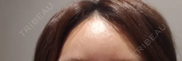 肌ヒアルロン酸注入（たるみ・シワ改善） 表参道スキンクリニック 表参道院 AFTER メイン用